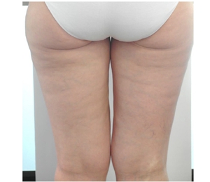 Cellulite-after