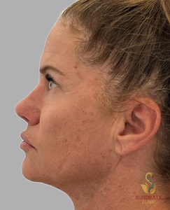 One week post NOUVADerm Mod ablation with spot treatment to pigmentation-before