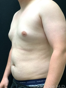 2 month post op BodyTite on chest to eliminate Gynecomastia-before