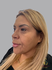 Cellenis Derma 11 ML kit, tear troughs and Cheeks-after