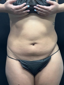 Lipo 360-after