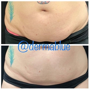 CoolSculpting - 2 Treatments-before
