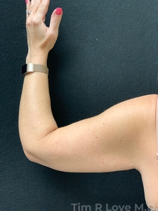 Brachioplasty-after