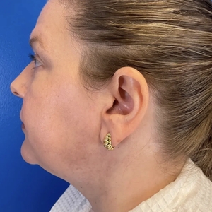 Lipo w Skin Tightening Face #8-before