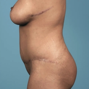 Mommy Makeover #4-after