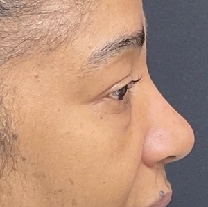 Brow & Eye Lift #3-before