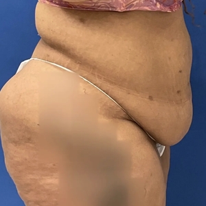 Tummy Tuck #12-before