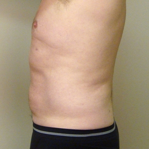 Liposuction #3-after