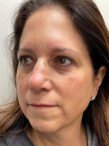 Helix 1 treatment-before