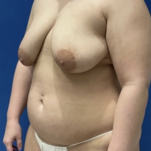 Mommy Makeover #1-before