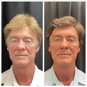 Botox / Voluma-before