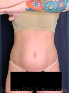 3 weeks after procedure-before