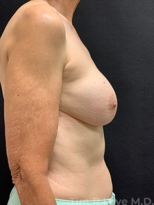 Implant Exchange-before