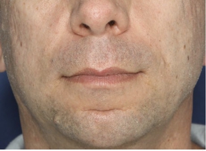 Post Acne Scars-after