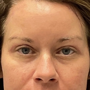 Brow & Eye Lift #2-after