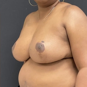 Breast Reduction #5-after