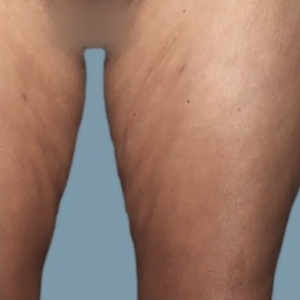Cellulite Reduction #4-after