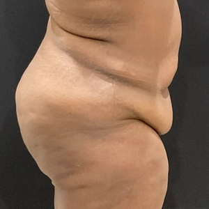 Tummy Tuck #4-before