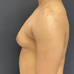 Lipo w BodyTite #9-before