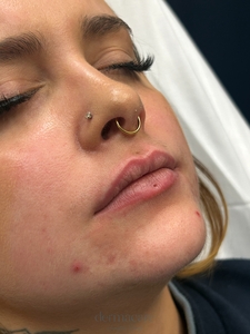 Whitney Devall RN. - Versa-before