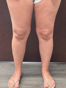 6 Emtone Inner Thighs-after