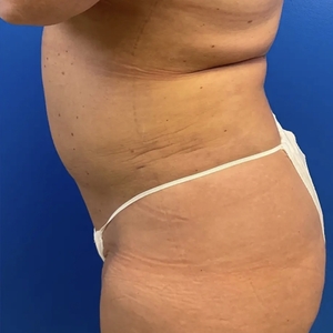 Lipo w Renuvion #3-after