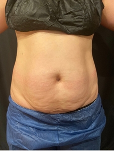 7 weeks post 1st CoolSculpting Treatment-before