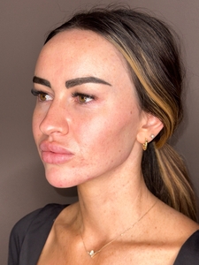 Demeri Cobb- Facial Balancing-after