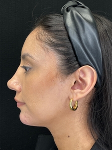 1 syringe Restylane Lyft in chin-after