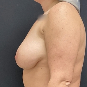 Breast Aug w/ Lift #23 455 cc-before