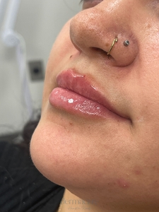 Danielle Glass RN. - Volbella-after