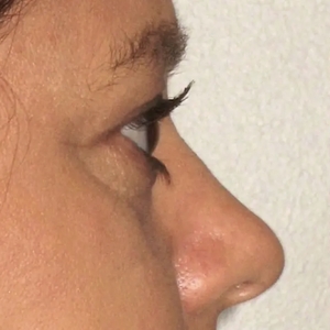 Brow & Eye Lift #5-before