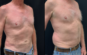 70 yrs old, 6'0 195lb, 1 month post op BodyTite Abdomen & Flanks-before