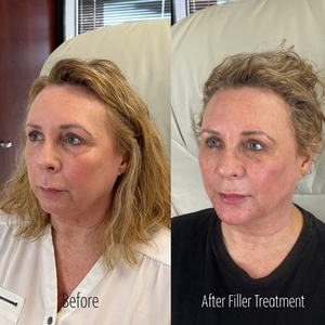 Filler B/A SBA 1-before