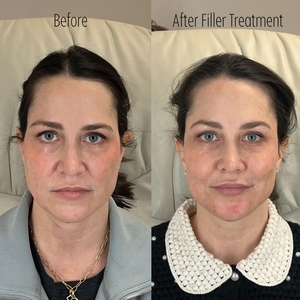 Filler B/A SBA 2-before