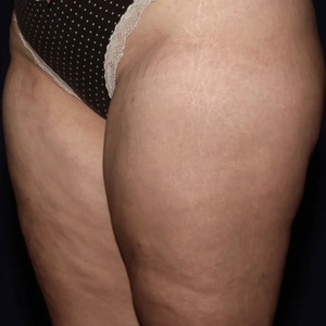 Lipo w BodyTite #7-after