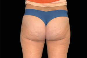 4 Treatments-after