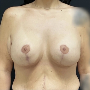 Breast Lift #14 (front)-after