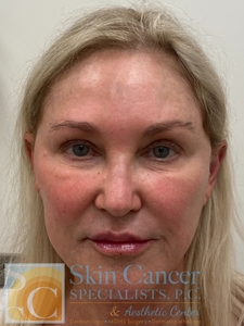 Lip Filler, Threads, Cheek Filler, and Botox-after