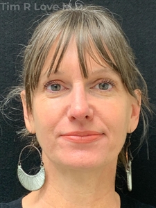 Rhinoplasty - Traditional-after