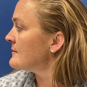 Lipo w Skin Tightening Face #7-after