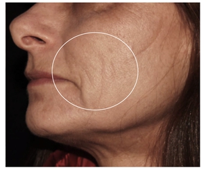 Dermal Thickening-after