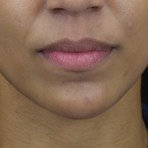 Chin Filler-after