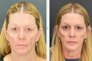 Botox - 20 u forehead, 24 u cf-before