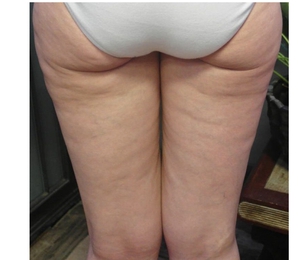 Cellulite-before