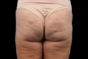 4 Treatments-before
