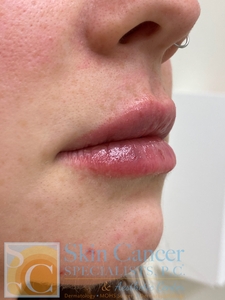 lip filler-after