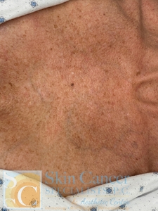 1 Treatment of Fraxel-before