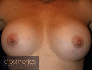 Mentor Smooth Round Saline: R385cc L380cc-after