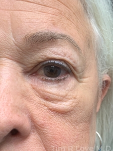 With periorbital Morpheus/Fractora-before